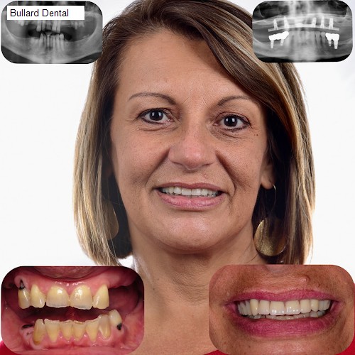 Bullard Dental